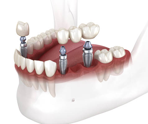 How Many Missing Teeth Can A Dental Bridge Replace?