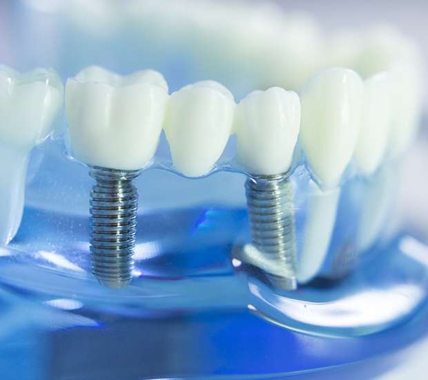 Murfreesboro Dental Implants