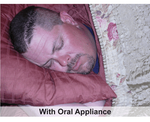 oral appliance