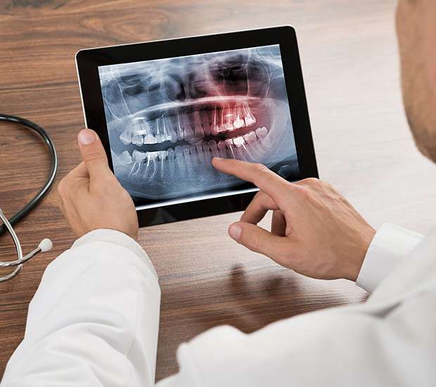 Murfreesboro Types of Dental Root Fractures